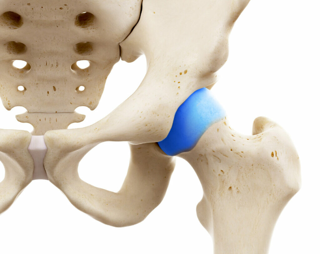 PINZAMIENTO FEMOROACETABULAR (FAI)