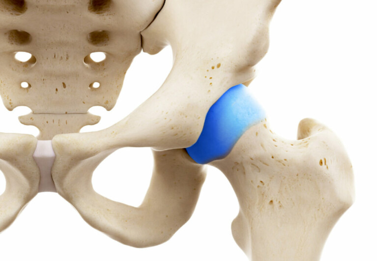 PINZAMIENTO FEMOROACETABULAR (FAI)