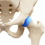PINZAMIENTO FEMOROACETABULAR (FAI)