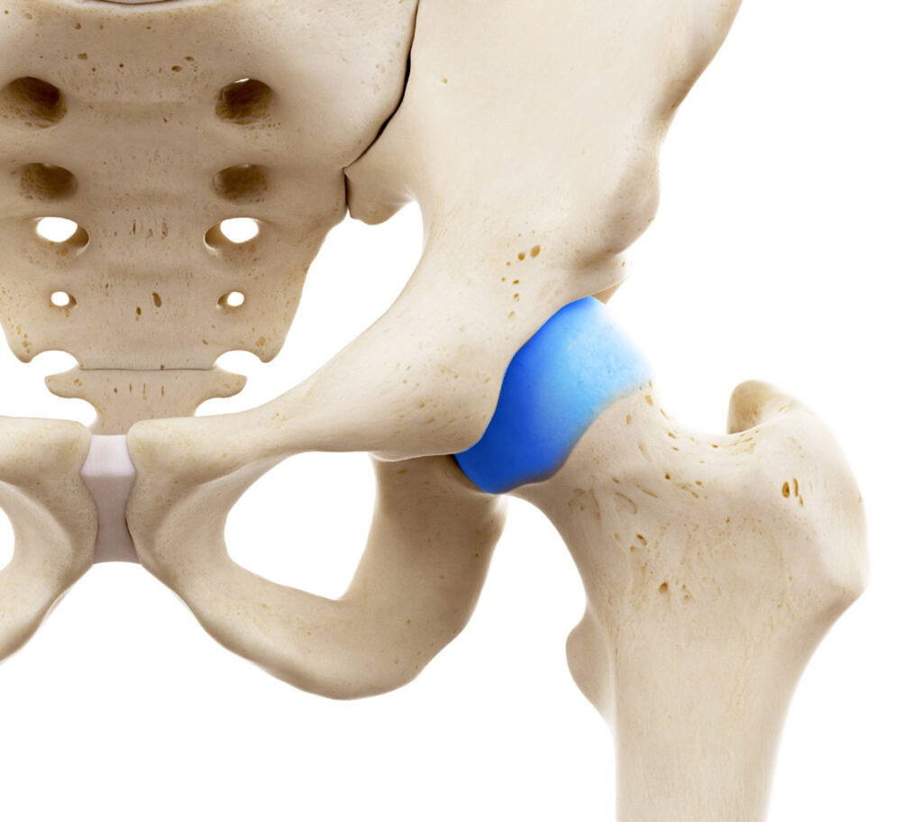 PINZAMIENTO FEMOROACETABULAR (FAI)