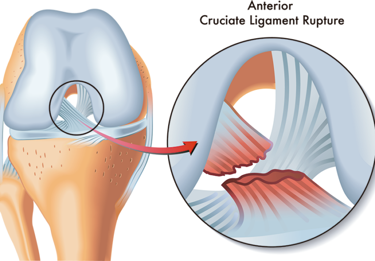 Rotura del ligamento cruzado anterior: tratamiento y recuperación
