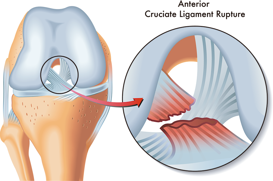Rotura del ligamento cruzado anterior: tratamiento y recuperación