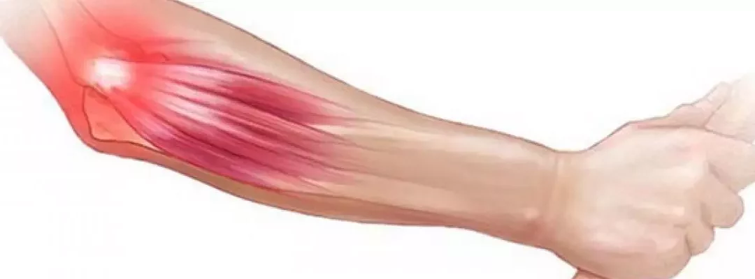 Dolor en el codo: por qué aparece y cómo solucionarlo sin dejar de usar el brazo